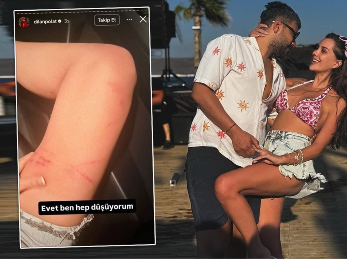 Dilan Polat Engin Polat'tan yediği dayağın izlerini paylaşıp sildi: Boşanacaksın oğlum benden