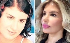 Türkücü Hatice Yanlış botoks kurbanı oldu