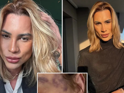 Estetik tutkusu Brezilyalı fenomen Junior Dutra'yı hayattan kopardı