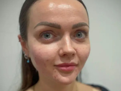 Burundaki sivilceleri sıkmak ölümcül sonuçlar doğurabilir