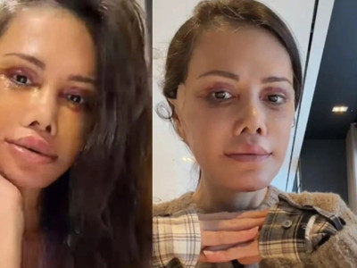 Yüz nakliyle gündem olan Didem Ceran'dan hastalık açıklaması