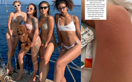 Melek Mosso Bali tatilinde hastalık kaptı: Bacakları kabardı