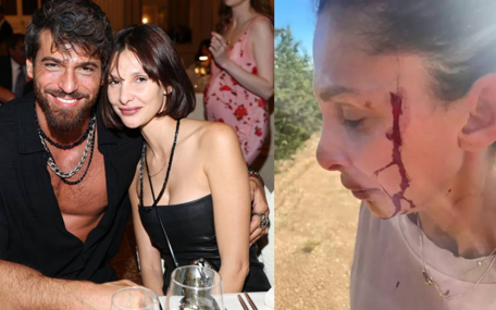 Can Yaman'ın sevgilisi, kanlar içinde paylaşım yaptı: Çocuğumun babasından şiddet görüyorum