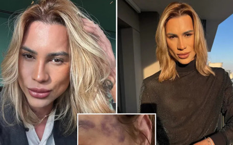 Estetik tutkusu Brezilyalı fenomen Junior Dutra'yı hayattan kopardı