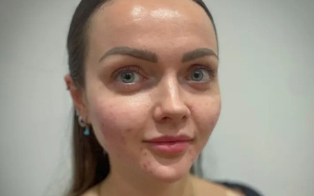 Balık spermi dolgusu trendi: Estetik dünyasında yeni akım