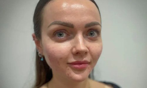 Balık spermi dolgusu trendi: Estetik dünyasında yeni akım