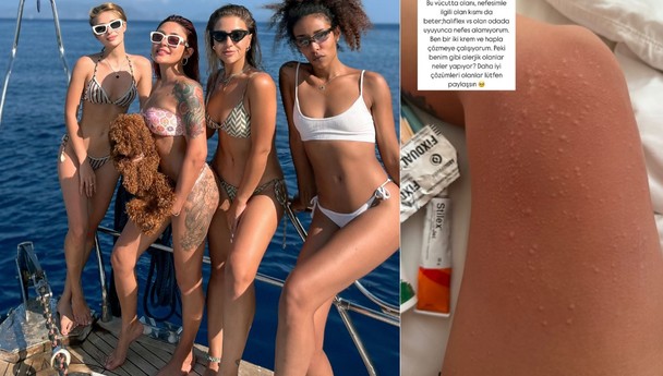 Melek Mosso Bali tatilinde hastalık kaptı: Bacakları kabardı