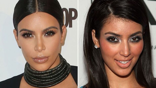 Kim Kardashian estetik mi yaptırdı?