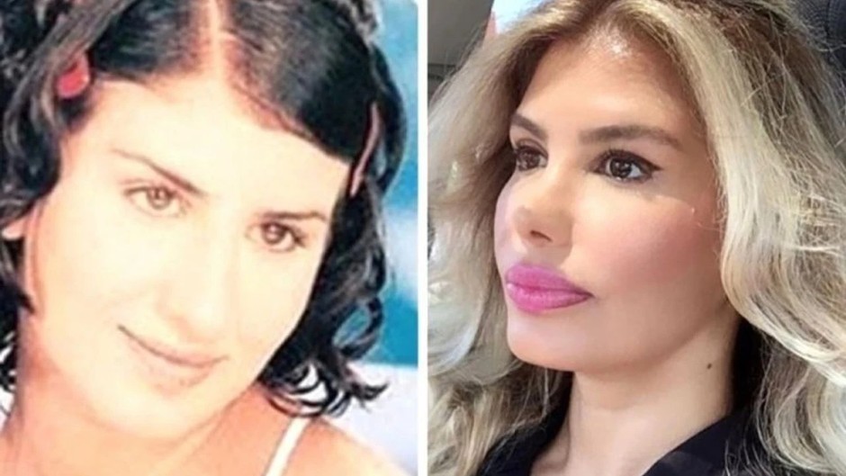Türkücü Hatice Yanlış botoks kurbanı oldu