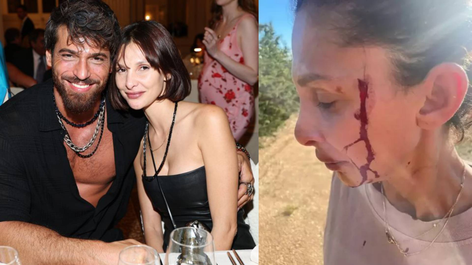 Can Yaman'ın sevgilisi, kanlar içinde paylaşım yaptı: Çocuğumun babasından şiddet görüyorum