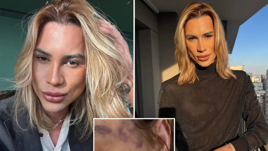 Estetik tutkusu Brezilyalı fenomen Junior Dutra'yı hayattan kopardı