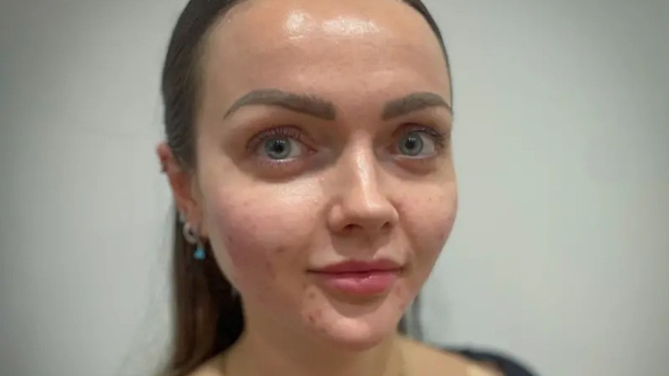 Burundaki sivilceleri sıkmak ölümcül sonuçlar doğurabilir