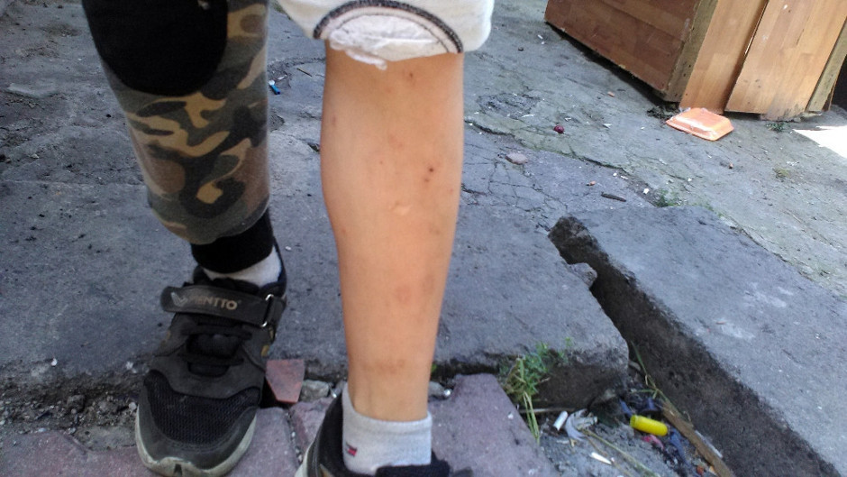 İstanbul'da sokakta oynayan çocukları pire ısırdı