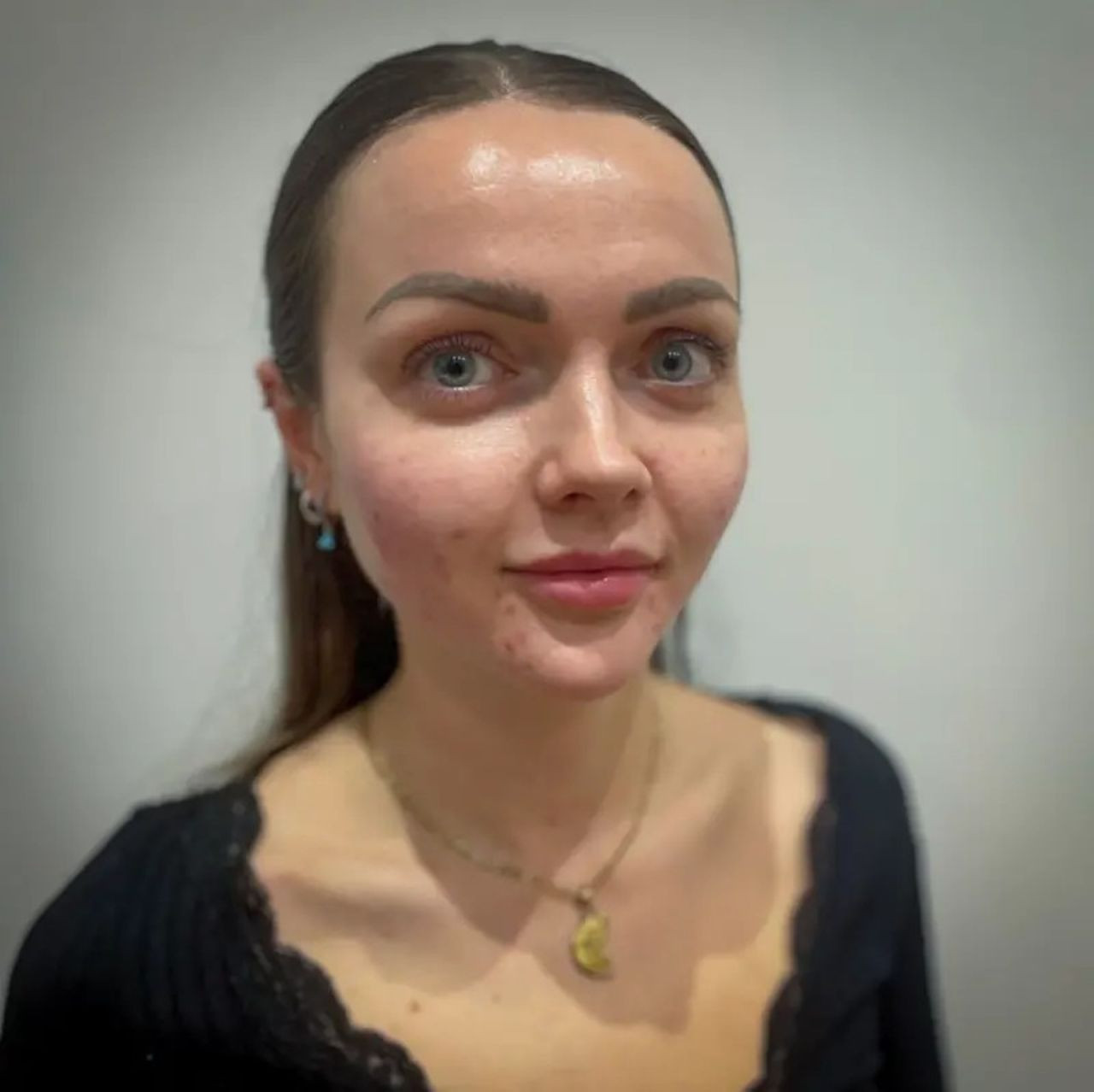 Balık spermi dolgusu trendi: Estetik dünyasında yeni akım - Resim: 1